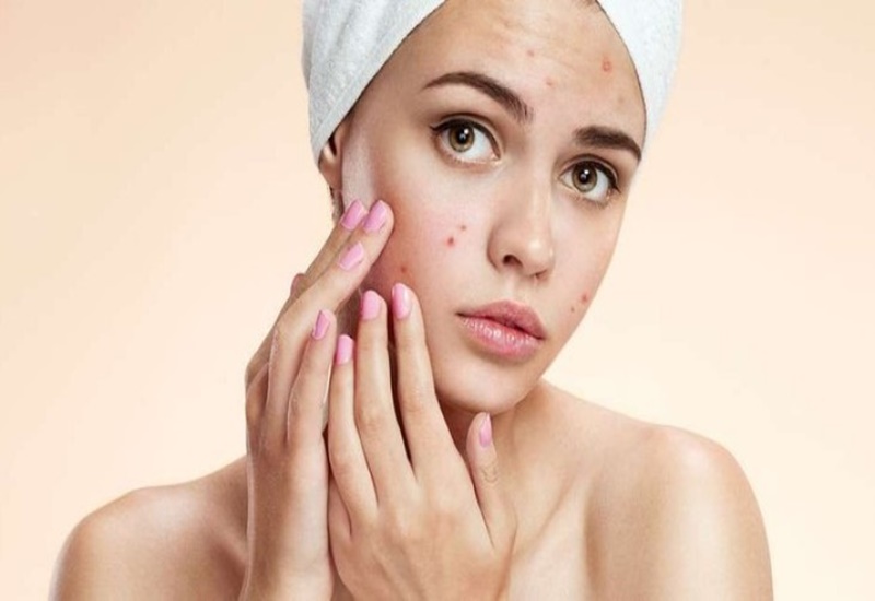 Mụn trứng cá là dấu hiệu của mất cân bằng nội tiết tố nữ