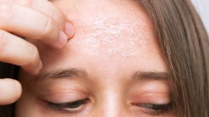 Một số trường hợp kích ứng, nhạy cảm với retinol có thể xuất hiện tình trạng khô da bong tróc