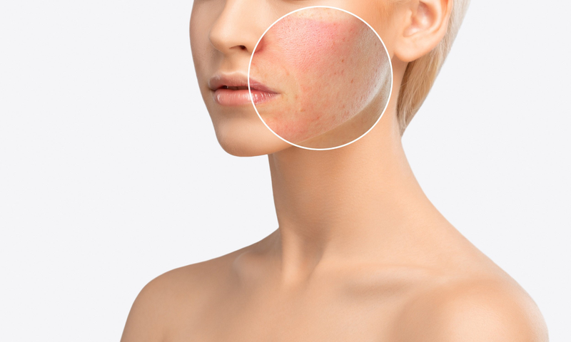Viêm dạ dị ứng - Một trong những dấu hiệu cho thấy da bị dị ứng, kích ứng